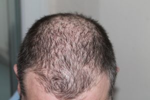 Alopecia