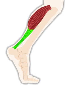 tendonitis